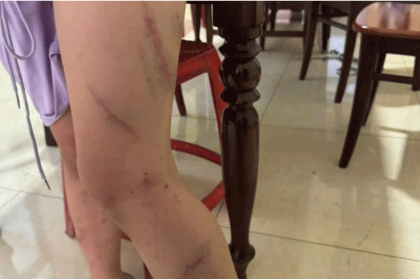 Con gái 9 tuổi nghi bị mẹ ruột tác động vật lý 34 vết bầm