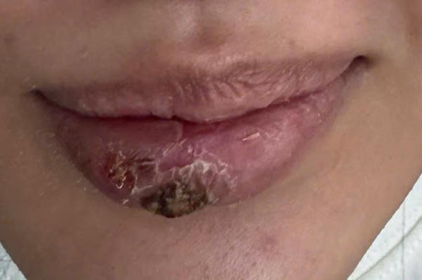 Cảnh báo nhiễm trùng nặng sau tiêm “giải filler” tại cơ sở không phép