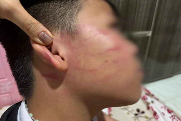 Gia Lai: Bé trai lớp 4 nhập viện sau buổi học thêm, gia đình tố bị giáo viên nước ngoài đánh vào mặt Gia Lai: Bé trai lớp 4 nhập viện sau buổi học thêm, gia đình tố bị giáo viên nước ngoài đánh vào mặt
