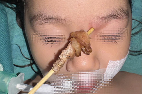 Bệnh viện Việt Đức: Cuộc hội chuẩn xuyên đêm cứu bé gái 2,5 tuổi bị que xiên thịt đâm sâu vào hốc mắt