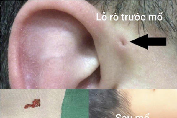 Hy hữu 4 người đàn ông trong 3 thế hệ cùng mắc dị tật bẩm sinh ở tai