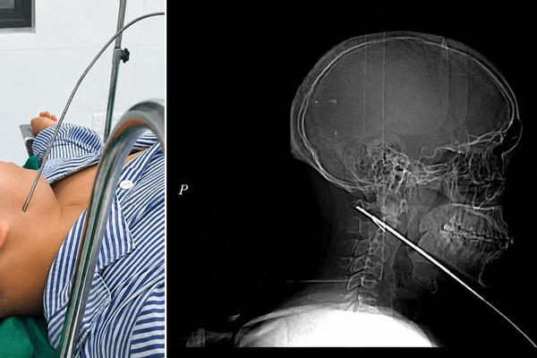 Nam thanh niên cấp cứu trong đêm sau khi bị mũi tên bắn cá xuyên sâu 15cm vào mặt Nam thanh niên cấp cứu trong đêm sau khi bị mũi tên bắn cá xuyên sâu 15cm vào mặt