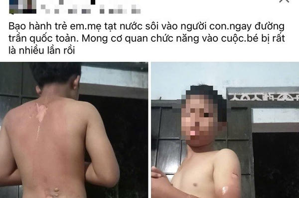 Công an thông tin vụ mẹ ruột tạt nước sôi lên người khiến con trai bị bỏng ở Đắk Lắk Công an thông tin vụ mẹ ruột tạt nước sôi lên người khiến con trai bị bỏng ở Đắk Lắk