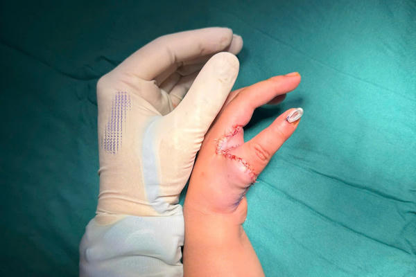 Phẫu thuật Cái hóa: Mở ra tương lai mới cho trẻ mắc dị tật thiểu sản ngón cái bẩm sinh