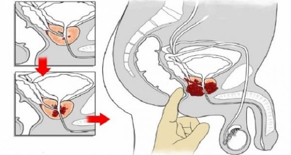 gừng và ung thư 0