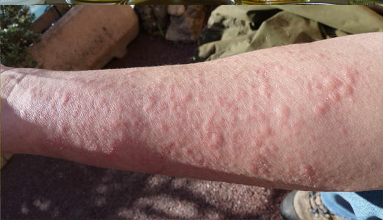 độc tố nhiều 0