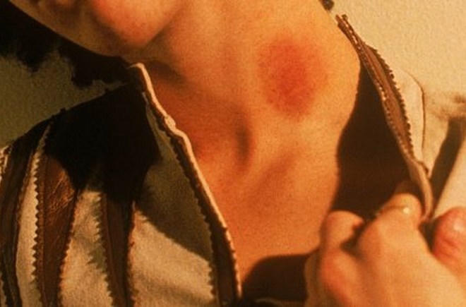 đột quỵ, dấu hiệu đột quỵ, triệu chứng đột quỵ, chữa trị đột quỵ, nhận biết đột quỵ, tử vong vì đột quỵ