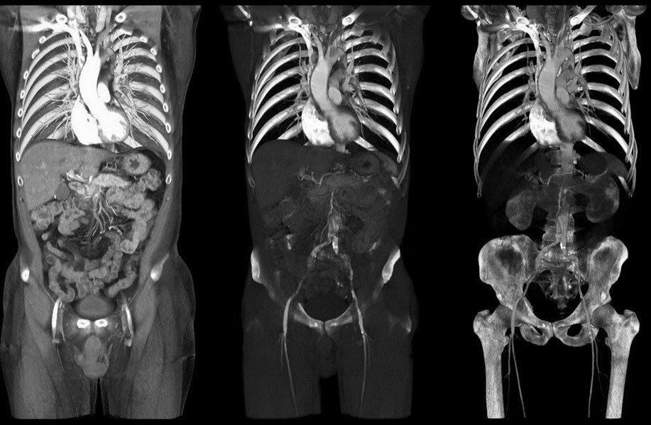 CẮT NHẦM THẬN, BÁC SĨ PHẪU THUẬT NHẦM