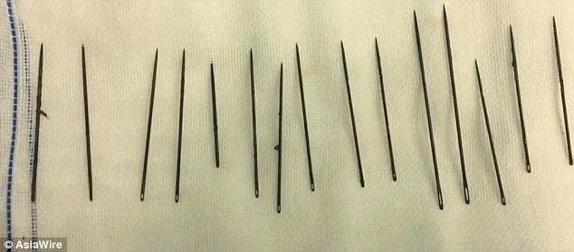 bac-si-toat-mo-hoi-khi-mo-gap-15-cay-kim-cho-quy-ong-thich-tu-suong-1