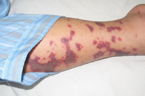 tuong-sot-xuat-huyet-co-gai-18-tuoi-o-ha-noi-bi-cach-ly-do-viem-nao-mo-cau