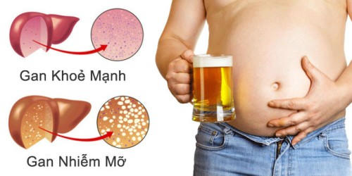 Bệnh gan nhiễm mỡ.