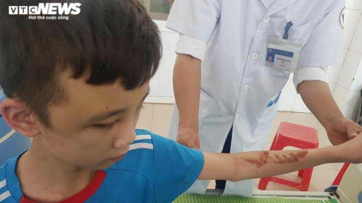 Cậu bé 14 tuổi bị chủ quán bánh xèo bạo hành với chi chít vết thương trên người, mặt bầm tím. (Ảnh VTC News)