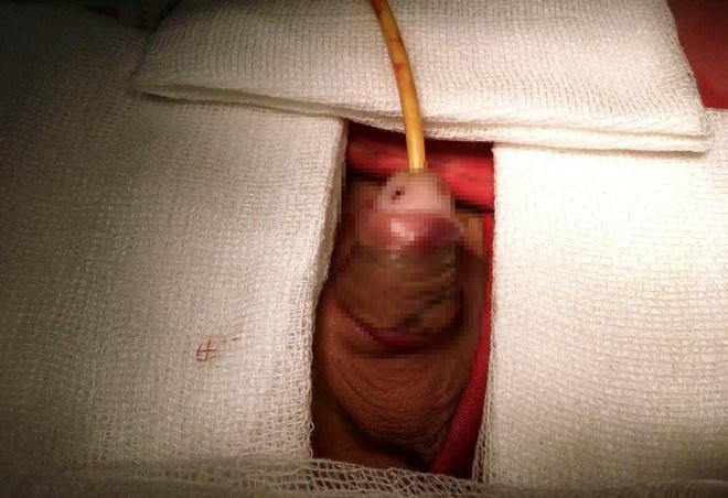 Kết quả hình ảnh cho kẹt dương vật