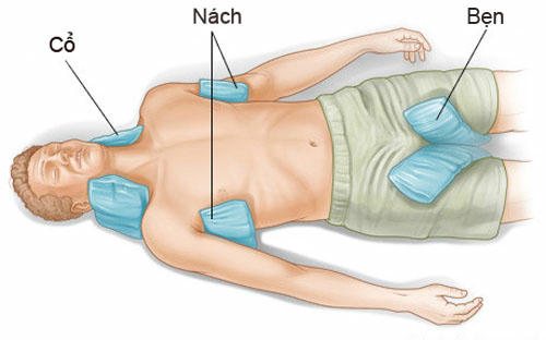 Để hạ nhiệt, nên áp túi nước đá vào nách, bẹn, cổ cho bệnh nhân say nắng.Ảnh:Examiner.