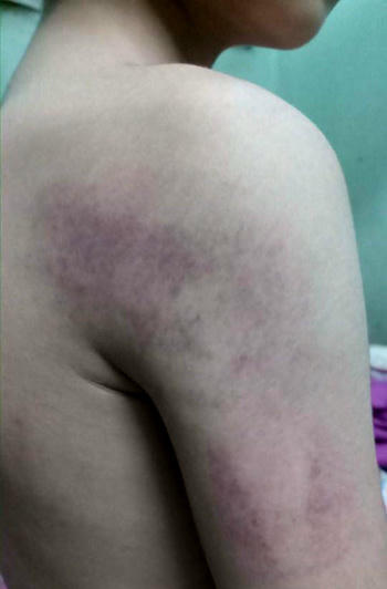 Bả vai và cánh tay học sinh Tùng (lớp 1, tiểu học Kiêu Kỵ, Hà Nội) bị tím bầm vì giáo viên đánh. Ảnh: Gia đình cung cấp.