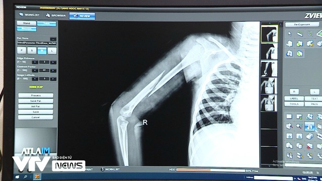 Bé gái bị bố đẻ bạo hành ở Bắc Ninh: Bố bảo đánh cho chừa mà con có mắc tội gì đâu - Ảnh 1. Bé gái bị bố đẻ bạo hành ở Bắc Ninh: Bố bảo đánh cho chừa mà con có mắc tội gì đâu - Ảnh 1.