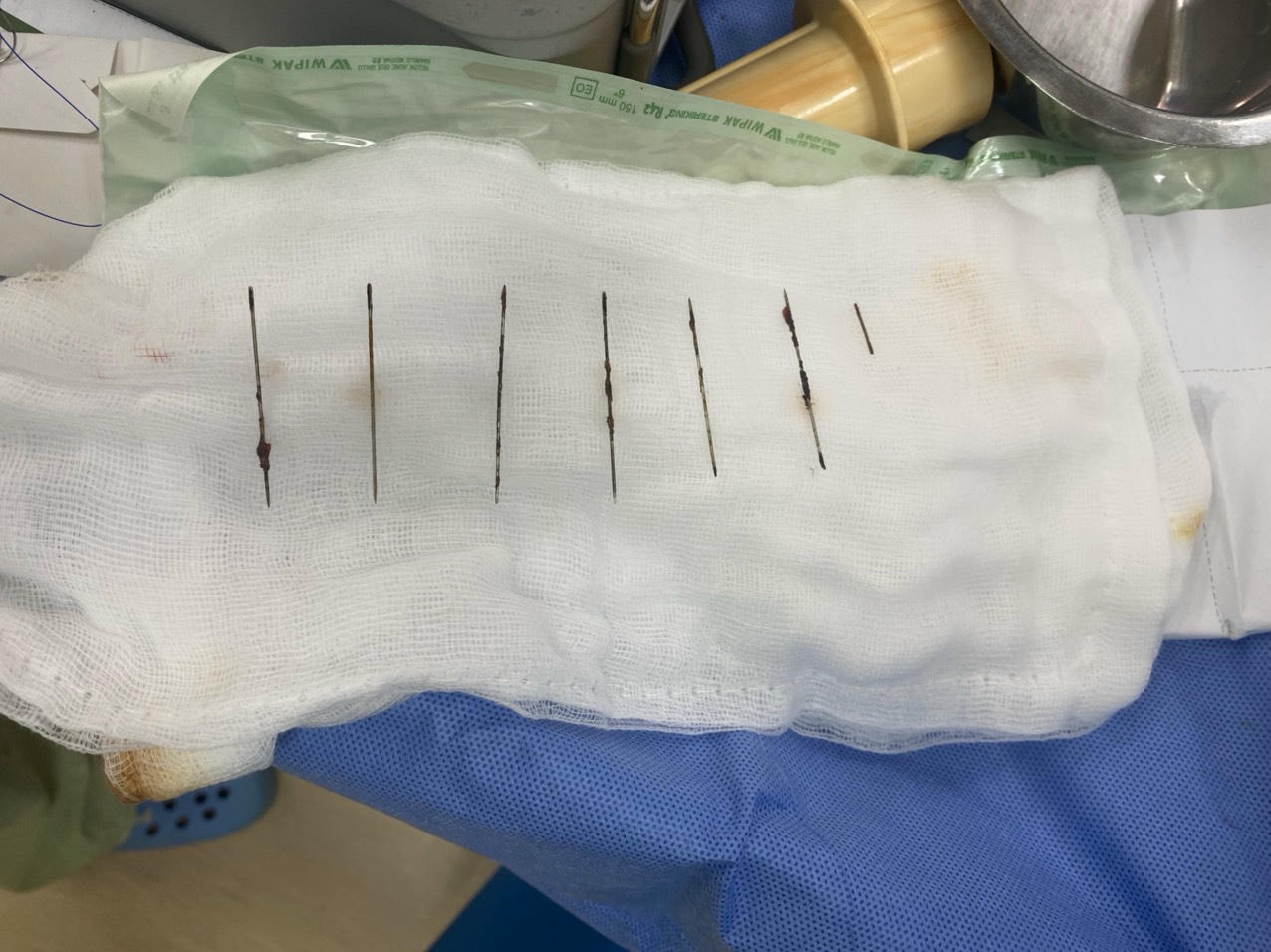 Bị stress tự lấy 7 cây kim đâm vào ngực - Ảnh 1.