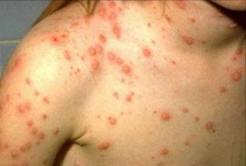 Ban thủy đậu là ban bọc nước, mọc toàn thân còn ban sởi là ban nhỏ mỏng trên mặt da, mọc theo thứ tự mặt, lan xuống chân.