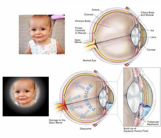 Ảnh minh họa: Bệnh Glôcôm thường gặp thể mãn tính biểu hiện âm thầm khó phát hiện.