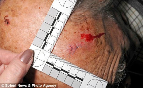 Nạn nhân và những vết thương trên đầu. Ảnh Viethome