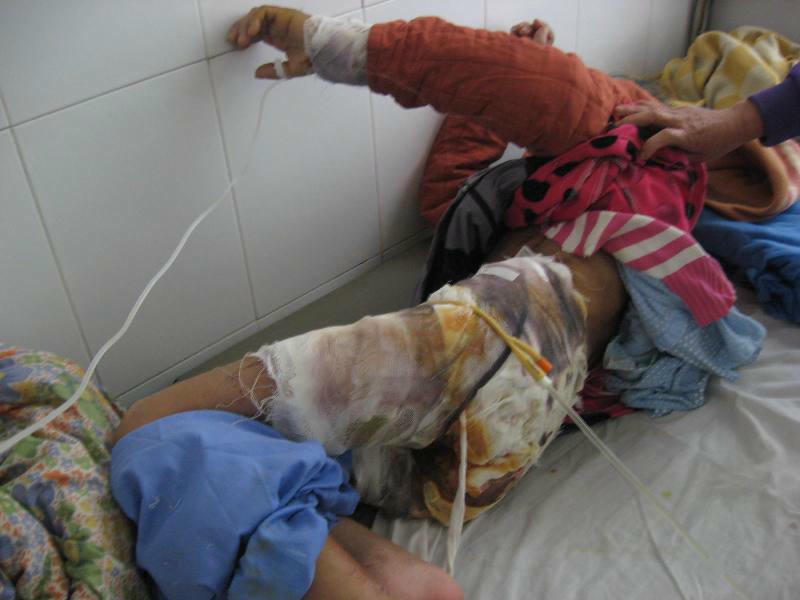 Những vết thương bị xối nước nóng nhiễm trùng và nhiều vùng da bị hoại tử.