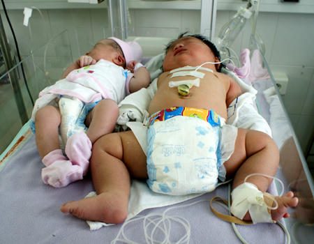 Cô bé sơ sinh bụ bẫm so với một bạn sinh cùng ngày. Ảnh: Thiên Chương