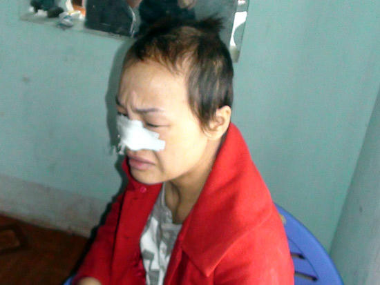 Những vết thương trên người chị D. 