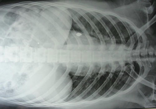 Viên đạn vẫn nằm trong người nạn nhân