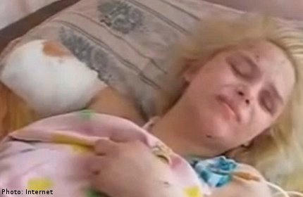Nạn nhân Oksana Makar khi điều trị tại bệnh viện. Ảnh: AFP