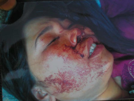 Mặt và đùi chị Vân bị thương rất nặng.