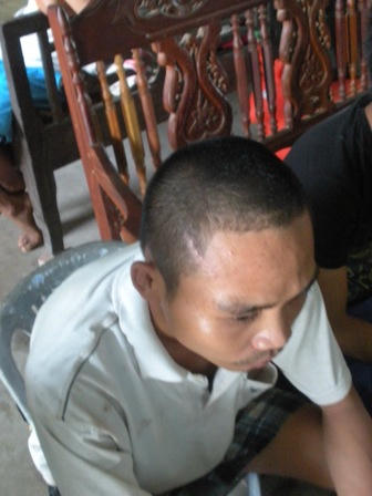 Vết thương trên đầu anh Đức bị Hoàng dùng gậy sắt đập vào gây chấn thượng so não.