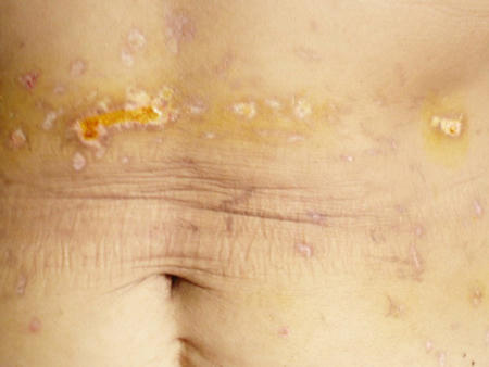 Phần bụng của bà Thanh đầy vết sẹo bỏng do bị “thầy” Định dùng nhang đốt để trị bệnh