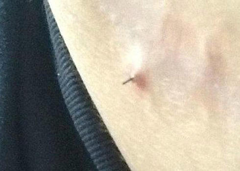 Chiếc kim đâm ra từ bụng bầu của Kelly. Ảnh: Metro.