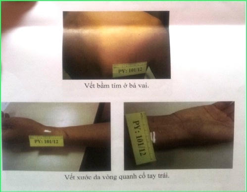 Thương tích của ông Khanh được mô tả trong Kết luận   giám định