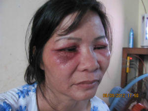 Đôi mắt chị Nguyễn Thị Tý sưng húp thâm đen, phát mủ
