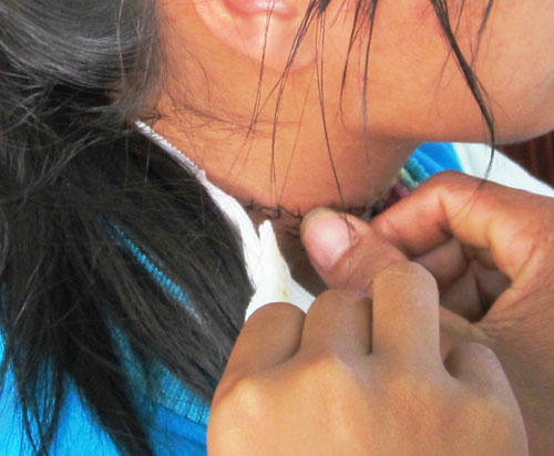 Vết cứa đã được khâu 12 mũi ở cổ em H.