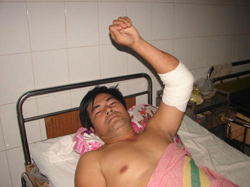  Anh Du đang điều trị vết thương tại BVĐK Tây Ninh