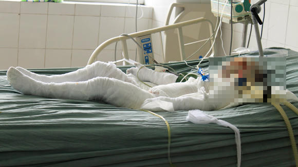 Cháu Ngọc tại Viện Bỏng quốc gia