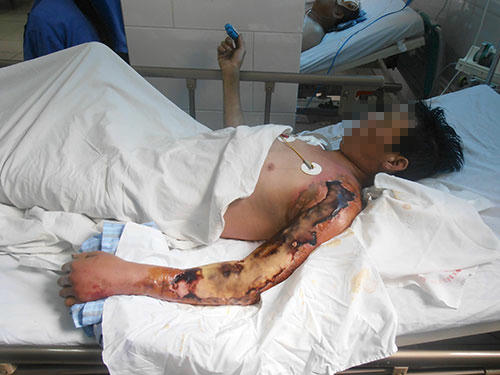 Một bệnh nhân bị vi khuẩn Aeromonas Hydrophyla “tấn công”,  gây hoại tử chi, được điều trị tại Bệnh viện Bệnh nhiệt đới Trung ương