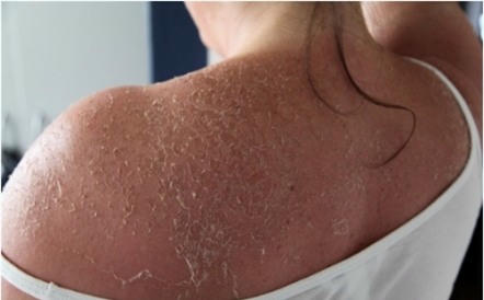 Biến chứng kinh hoàng từ kem lột trắng