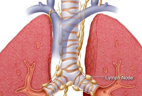 Có những triệu chứng này nghĩ ngay ung thư phổi