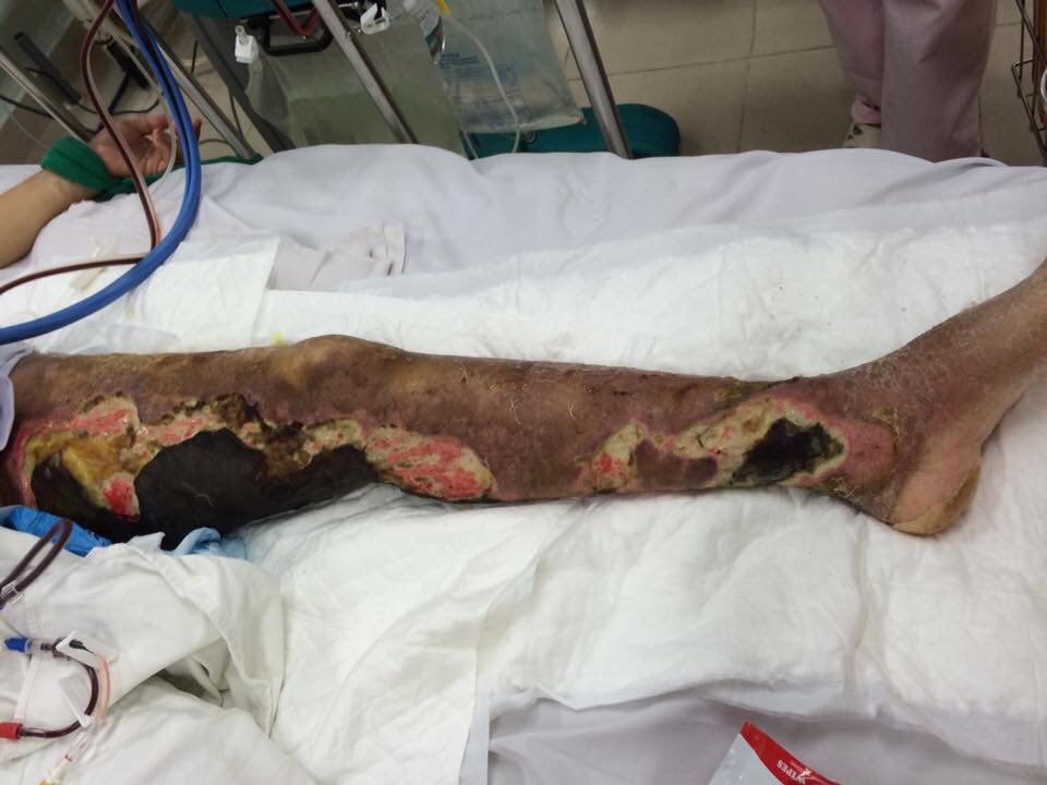 Hoại tử chân vì tự “chữa bệnh” qua google