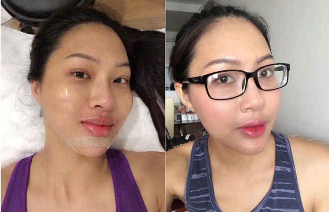 Ồn ào chuyện Đại diện Việt ở Hoa hậu Thế giới bị tố thẩm mỹ