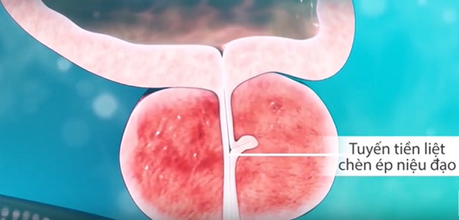 Tiểu đêm, tiểu khó - cuộc chiến khó tránh của tuổi già