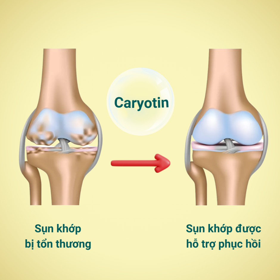 Chiết xuất Caryotin từ cây Đủng đỉnh hỗ trợ điều trị bệnh xương khớp