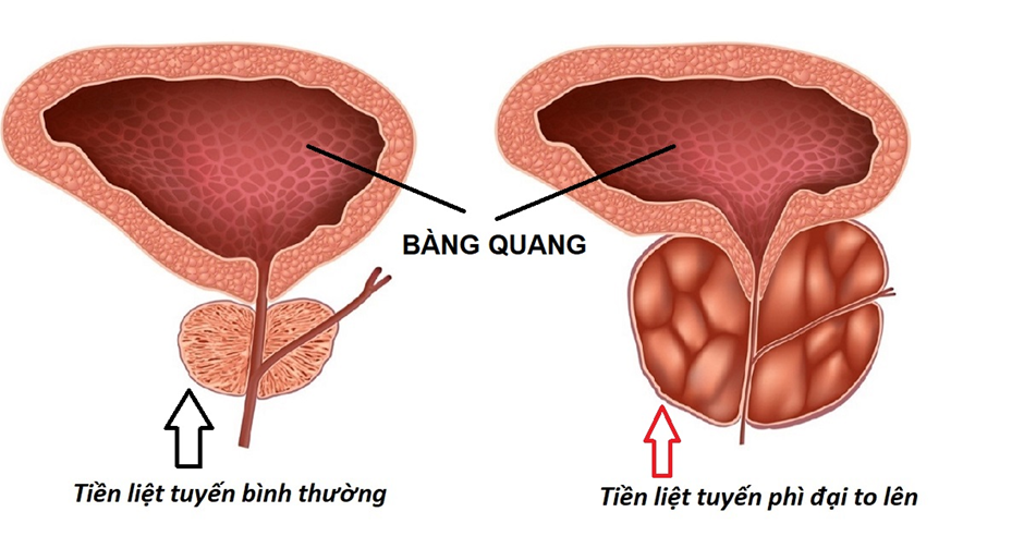 Phì đại tuyến tiền liệt: Triệu chứng và cách xử lý mới nhất