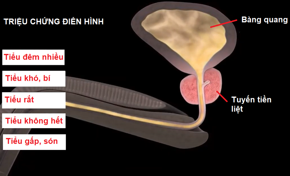 Phì đại tuyến tiền liệt: Triệu chứng và cách xử lý mới nhất