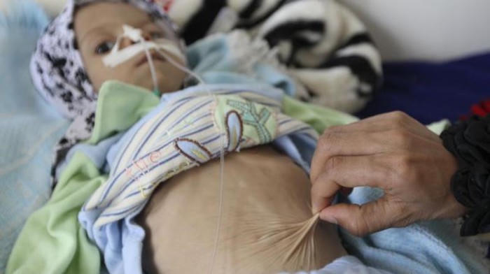 85.000 trẻ dưới 5 tuổi ở Yemen chết vì 'đói'