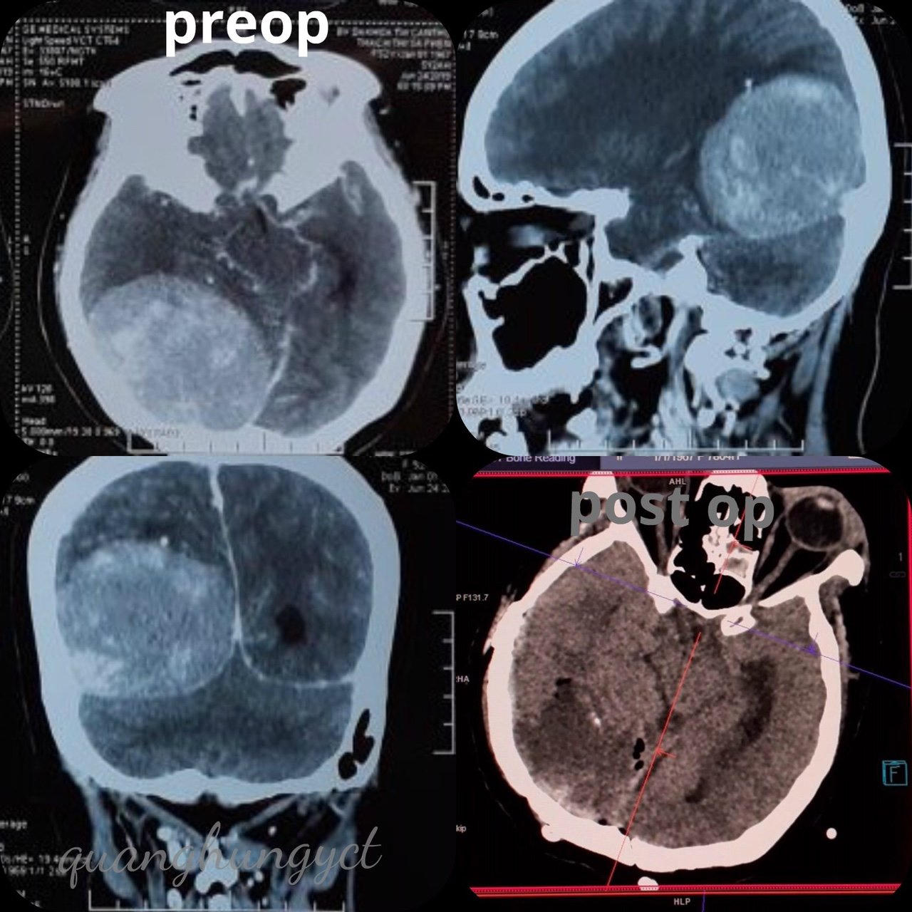 Cứu sống một bệnh nhân u màng não khổng lồ