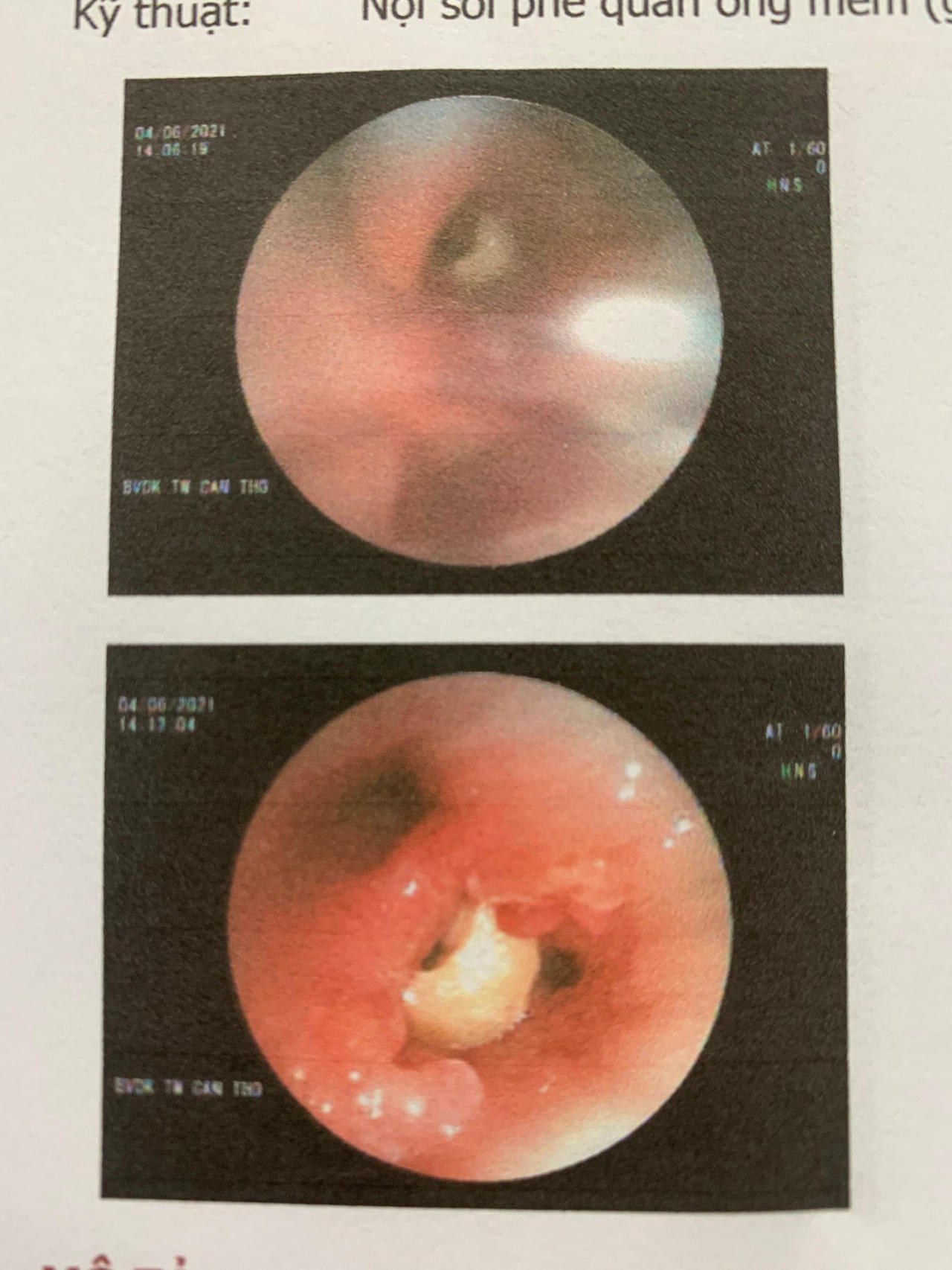 Hy hữu phát hiện hạt đậu phộng trong phổi cụ ông 95 tuổi 
